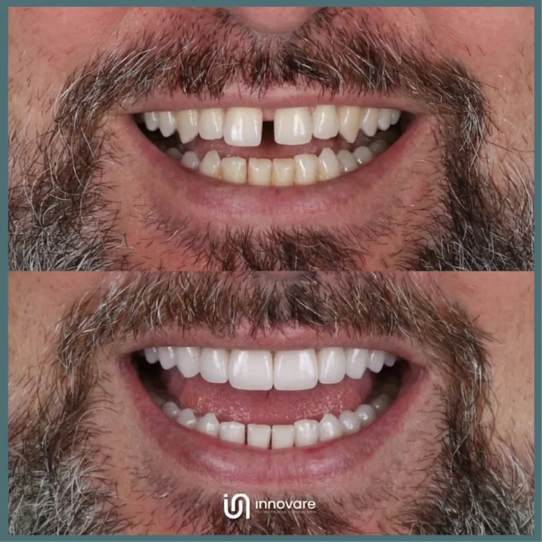 antes e deois 9 1_1x