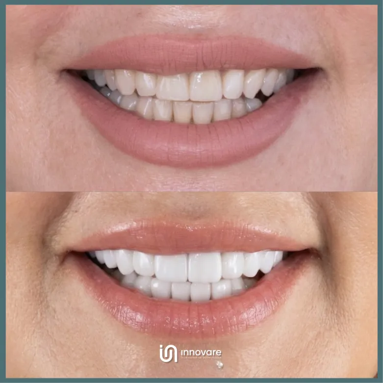 antes e depois 11 1_1x