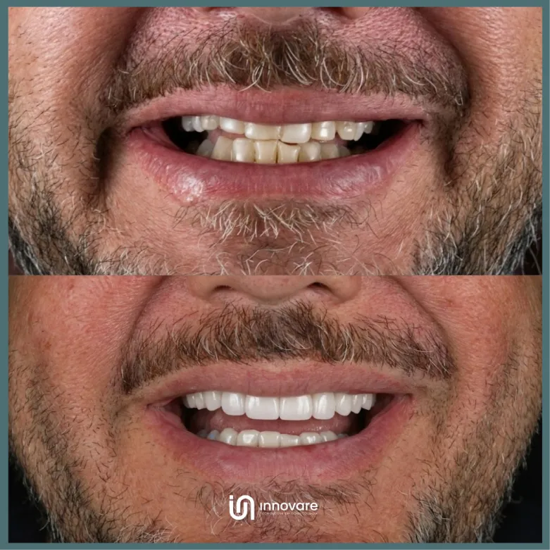 antes e depois 13 1_1x