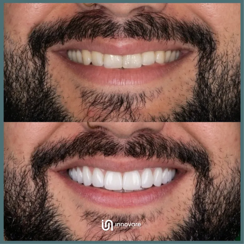 antes e depois 15 1_1x