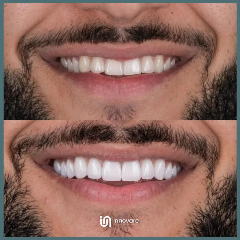 antes e depois 16 1_1x
