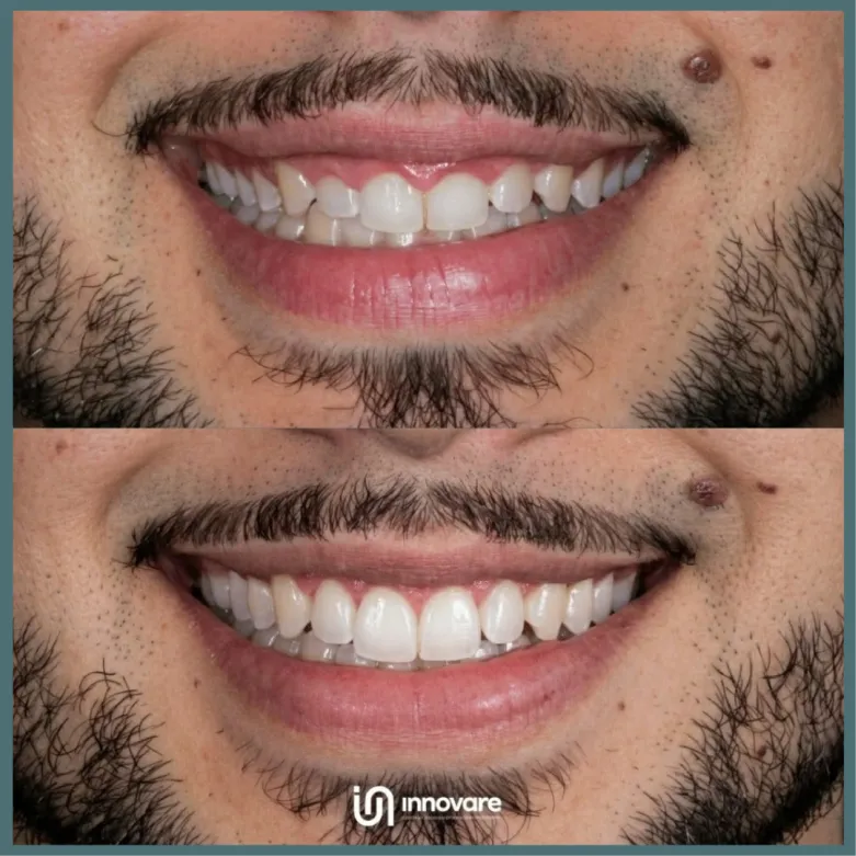 antes e depois 2 1_1x