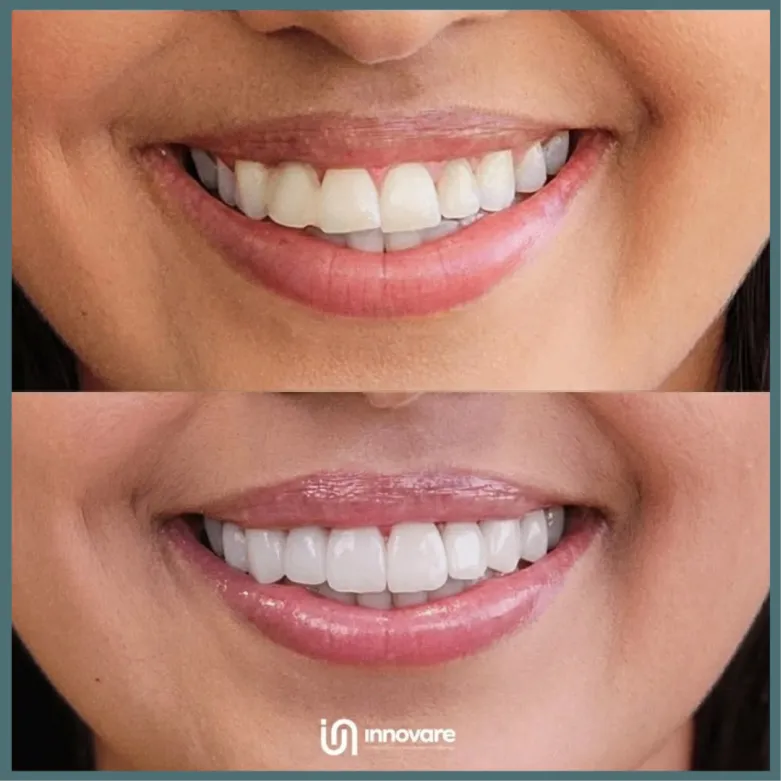 antes e depois 3 1_1x