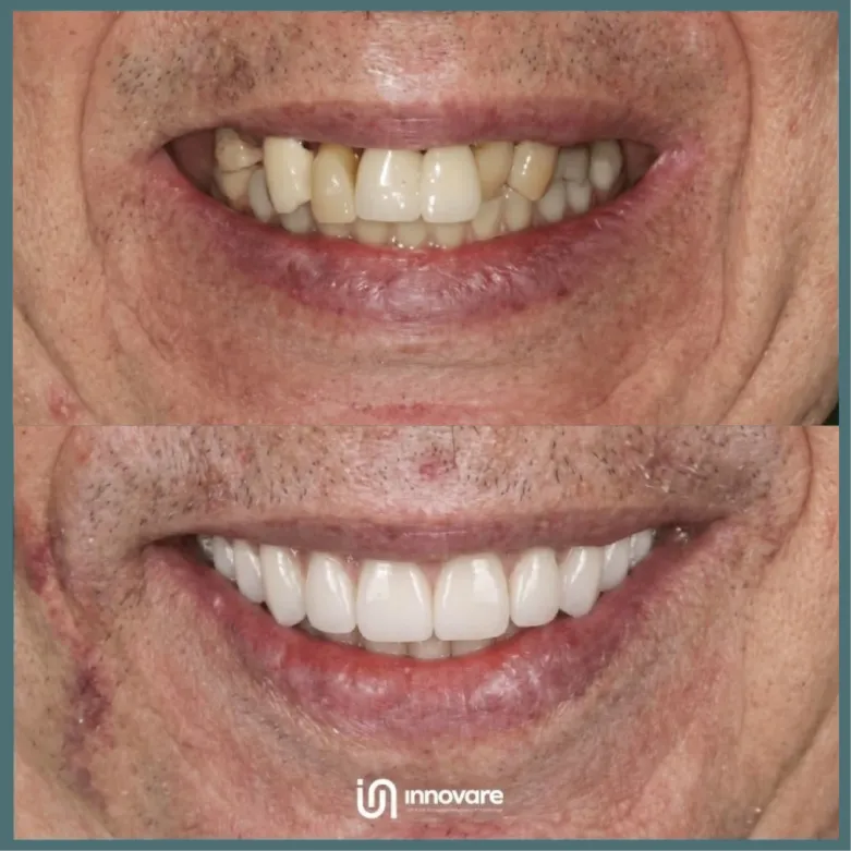 antes e depois 5 1_1x