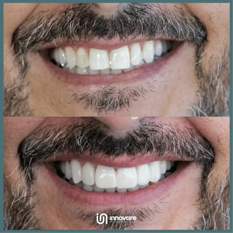 antes e depois 6 1_1x