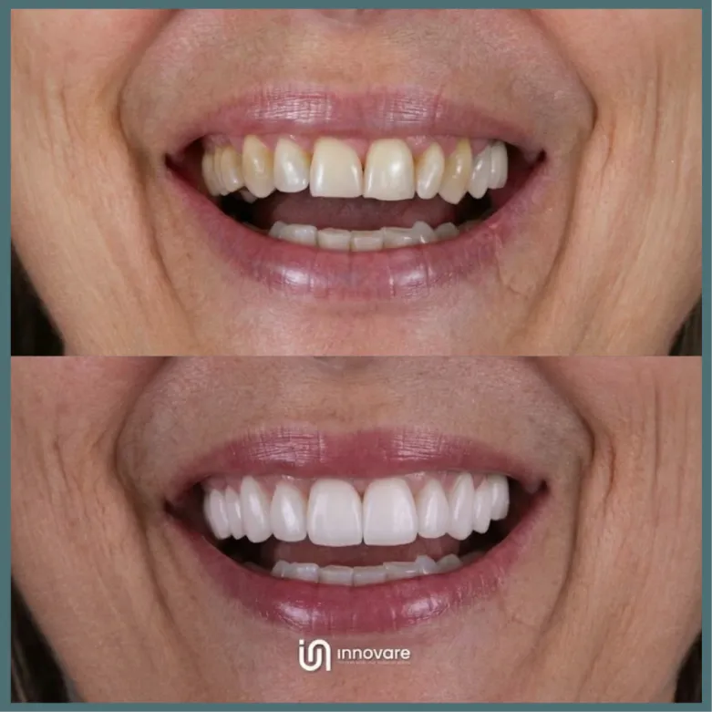 antes e depois 7 1_1x