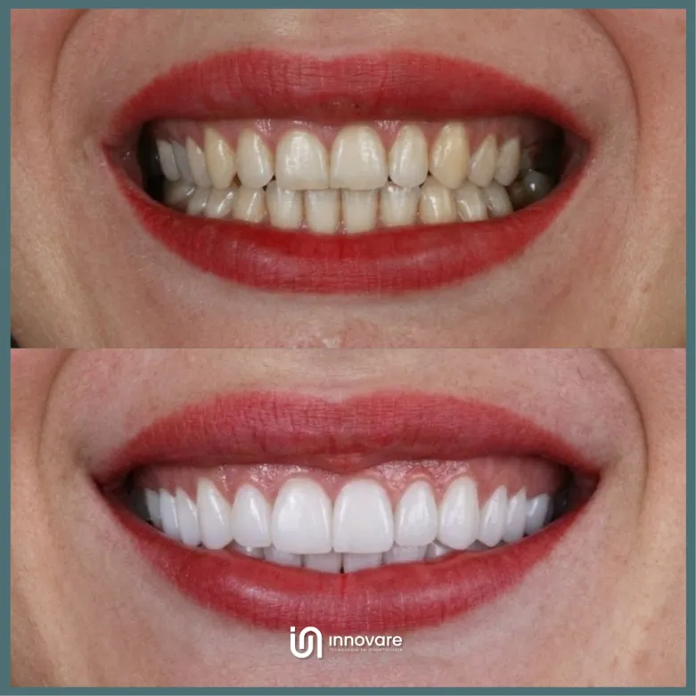antes e depois 8 1_1x